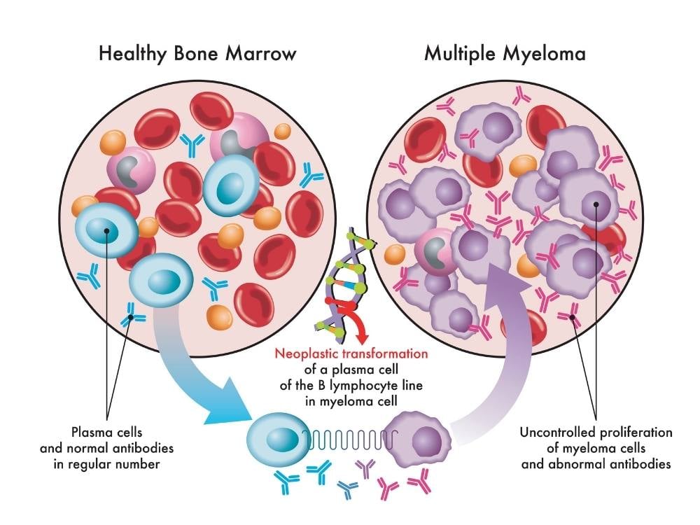 Multiple Myeloma | Oncologists In The Willamette Valley, Oregon